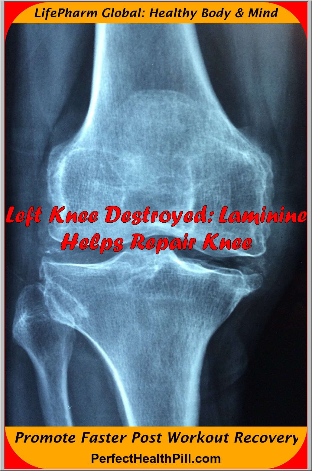 Laminine and knee surgery