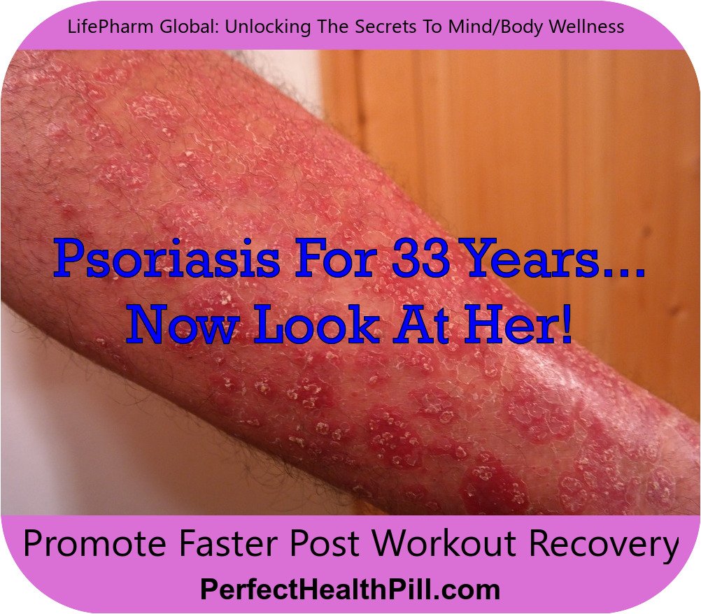 Laminine Psoriasis 33 years